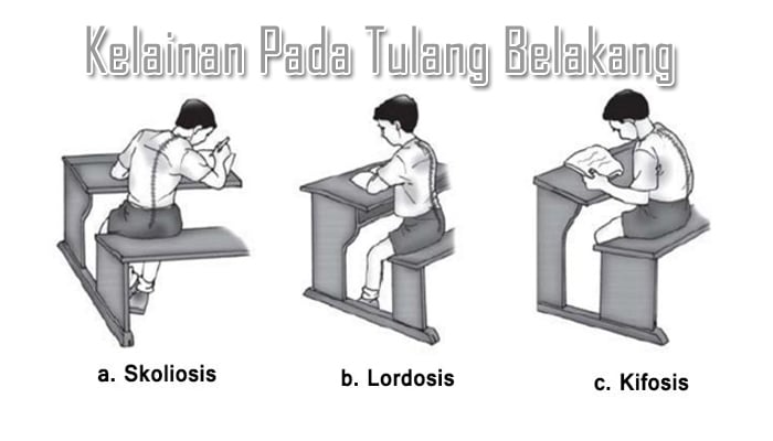 3 Kelainan Pada Tulang Belakang Dengan Penyebab dan Penjelasannya Lengkap –  Sekolahan.Co.Id